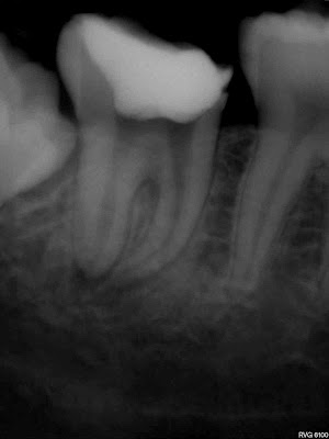 Endodoncja mikroskopowa zabieg wykonywany w Krakowie