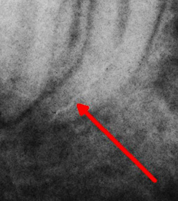 Zdjęcie RTG - endodoncja Kraków