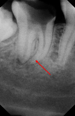 zabieg endodoncji mikroskopowej